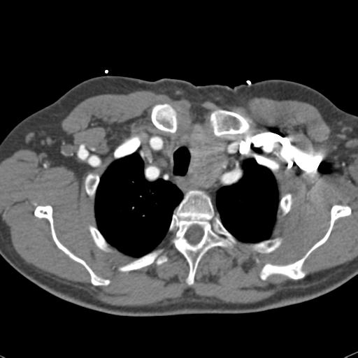 Aortic intramural hematoma (Radiopaedia 31139-31838 B 14).jpg
