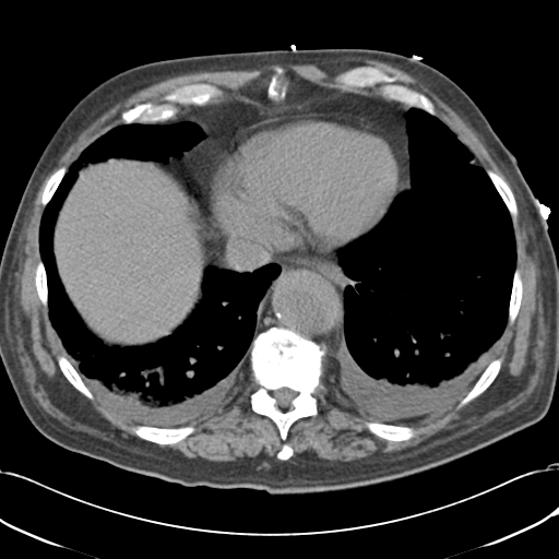 Aortic intramural hematoma (Radiopaedia 34260-35540 Axial non-contrast 48).png