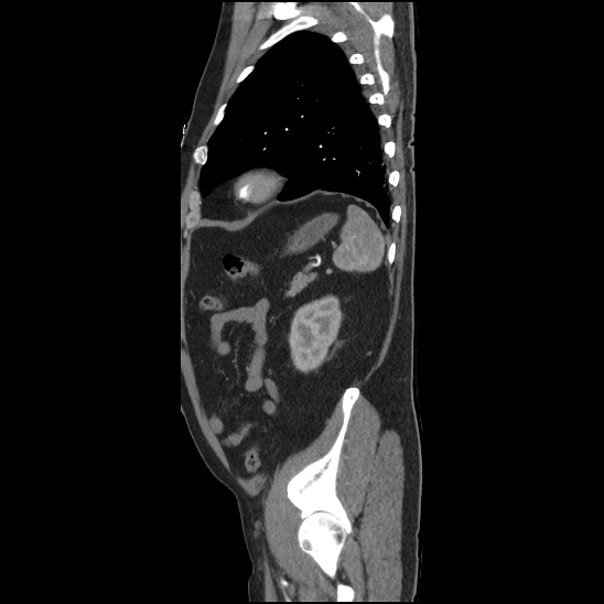 Aortic intramural hematoma (type B) (Radiopaedia 79323-92387 H 45).jpg