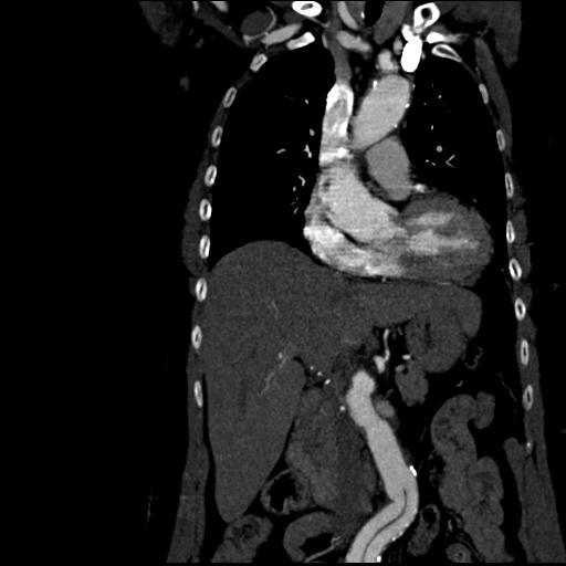 File:Aortic intramural hematoma from penetrating atherosclerotic ulcer (Radiopaedia 31137-31836 C 26).jpg