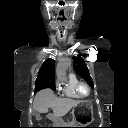 File:Aortic intramural hematoma with dissection and intramural blood pool (Radiopaedia 77373-89491 C 14).jpg