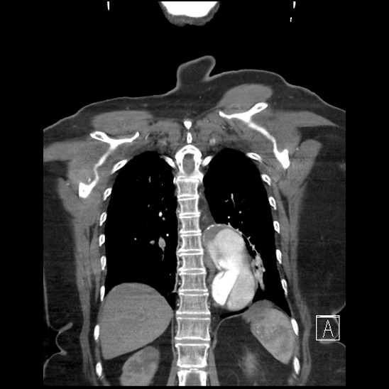 Aortic intramural hematoma with dissection and intramural blood pool (Radiopaedia 77373-89491 C 50).jpg