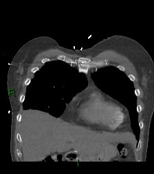 Aortic valve endocarditis (Radiopaedia 87209-103485 D 57).jpg