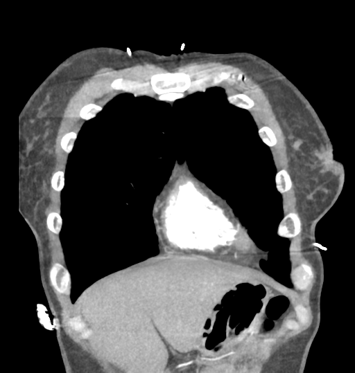 File:Aortic valve non-coronary cusp thrombus (Radiopaedia 55661-62189 C 16).png
