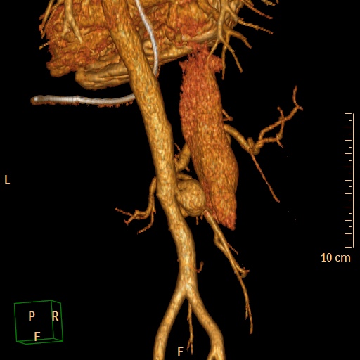 File:Aorto-left renal vein fistula (Radiopaedia 45534-49628 D 32).jpg