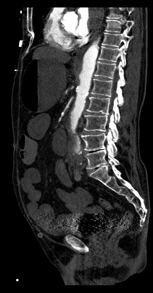 Aortoduodenal fistula (Radiopaedia 75286-86415 F 24).jpg