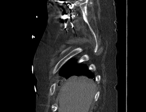 Aortoesophageal fistula with endovascular repair (Radiopaedia 73781-84592 Sagittal C+ CTPA 11).jpg