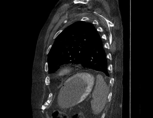 File:Aortoesophageal fistula with endovascular repair (Radiopaedia 73781-84592 Sagittal C+ CTPA 163).jpg