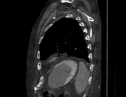 File:Aortoesophageal fistula with endovascular repair (Radiopaedia 73781-84592 Sagittal C+ CTPA 164).jpg
