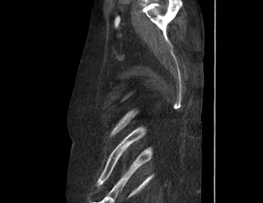 Aortoesophageal fistula with endovascular repair (Radiopaedia 73781-84592 Sagittal C+ CTPA 190).jpg