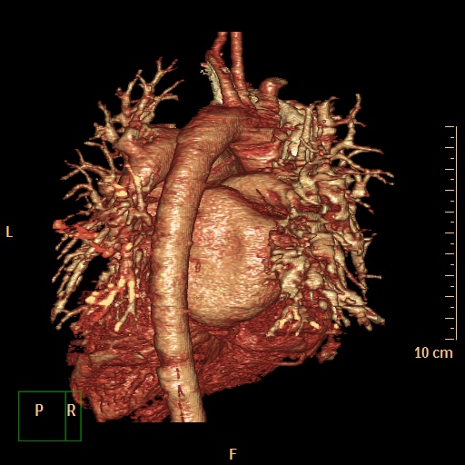 File:Aortopulmonary septal defect (Radiopaedia 41990-45013 3D reconstruction 12).jpg