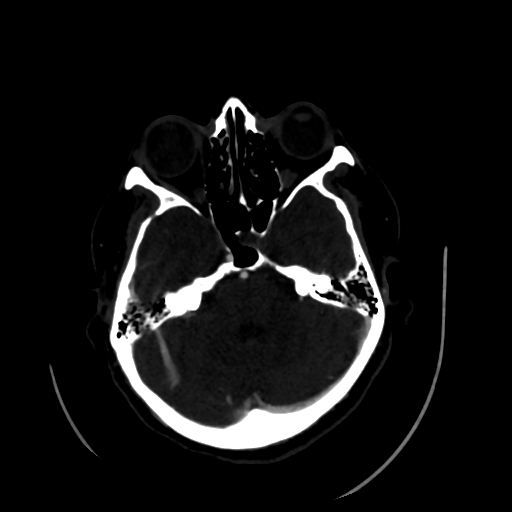 Aplasia of the internal carotid artery (Radiopaedia 61082-68960 A 21).jpg