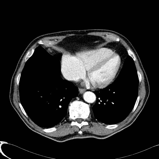File:Appendiceal adenocarcinoma complicated by retroperitoneal abscess (Radiopaedia 58007-65039 B 8).jpg