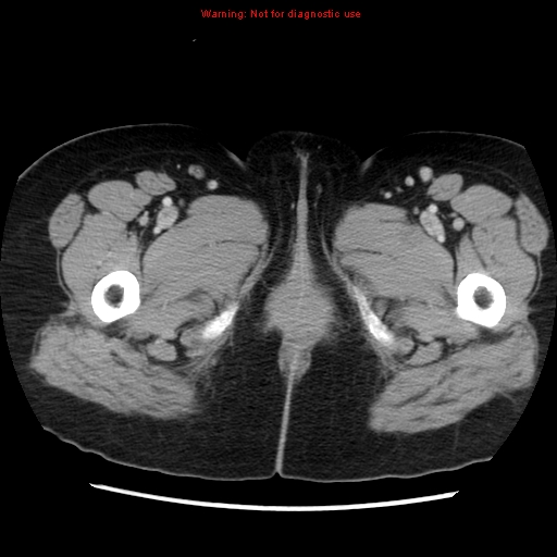 Appendiceal mucinous cystadenoma (Radiopaedia 8263-9111 Axial liver window 89).jpg