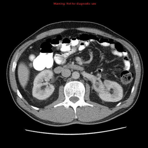 File:Appendicitis and renal cell carcinoma (Radiopaedia 17063-16760 A 23).jpg