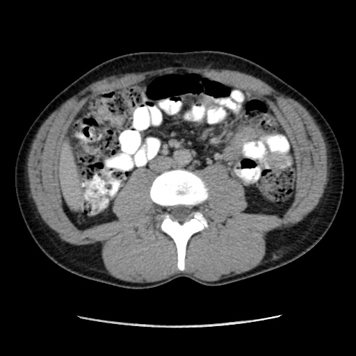 File:Appendicitis complicated by post-operative collection (Radiopaedia 35595-37113 A 38).jpg