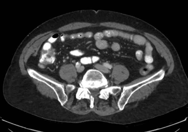 Appendicitis due to chicken fibula (Radiopaedia 74314-85198 A 11).jpg