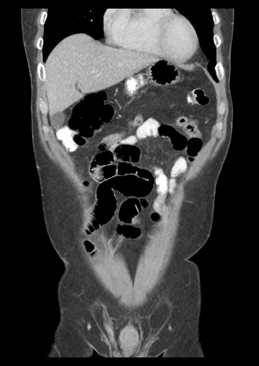 Appendicitis with thickening of the terminal ileum (Radiopaedia 42432-45550 B 14).png