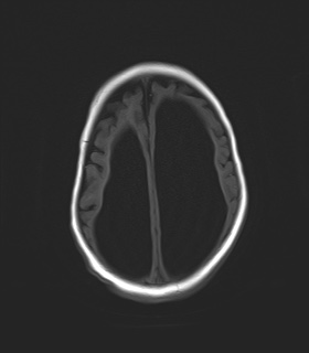 File:Aqueductal stenosis (Radiopaedia 73974-84802 Axial T1 19).jpg
