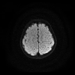 Arachnoid cyst - middle cranial fossa (Radiopaedia 86780-102938 Axial DWI 5).jpg