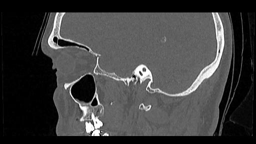 Arcuate foramen (Radiopaedia 89833-106944 Sagittal bone window 4).jpg