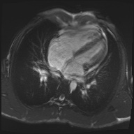 File:Arrhythmogenic right ventricular cardiomyopathy (Radiopaedia 57972-64966 A 11).jpg