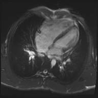 File:Arrhythmogenic right ventricular cardiomyopathy (Radiopaedia 57972-64966 Axial 17).jpg