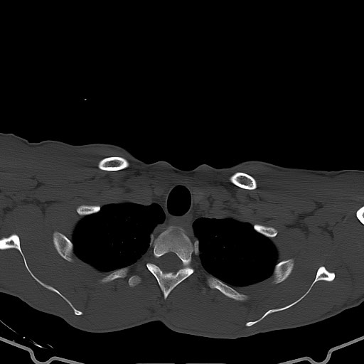 Arrow injury to the brain (Radiopaedia 72101-82607 Axial bone window 3).jpg