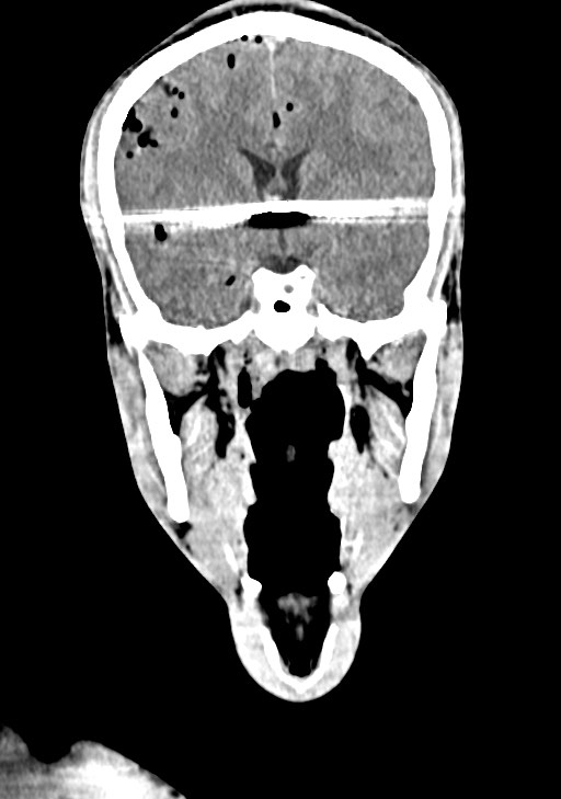 Arrow injury to the brain (Radiopaedia 72101-82607 Coronal non-contrast 37).jpg