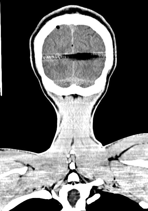 Arrow injury to the brain (Radiopaedia 72101-82607 Coronal non-contrast 64).jpg
