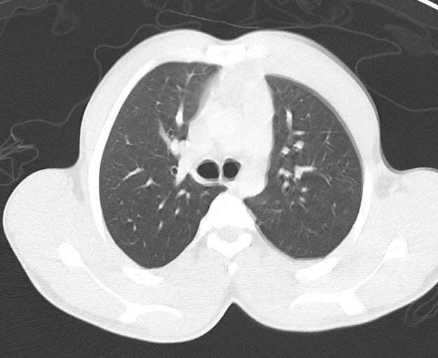 File:Arrow injury to the chest (Radiopaedia 75223-86321 Axial lung window 21).jpg