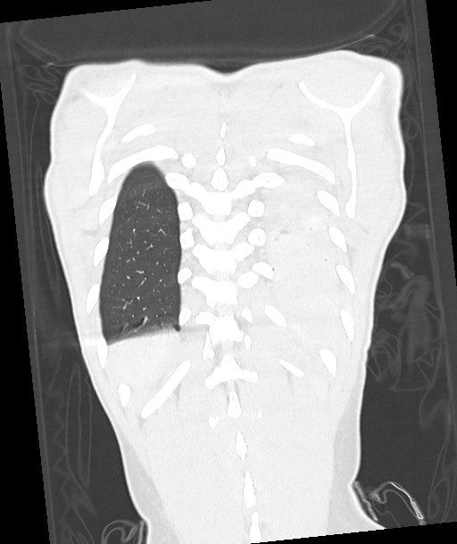 Arrow injury to the chest (Radiopaedia 85367-100975 Coronal lung window 111).jpg