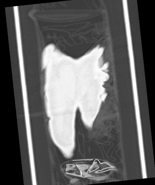 Arrow injury to the chest (Radiopaedia 85367-100975 Coronal lung window 126).jpg