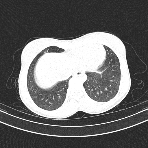 Arteria lusoria (Radiopaedia 88528-105192 Axial lung window 48).jpg