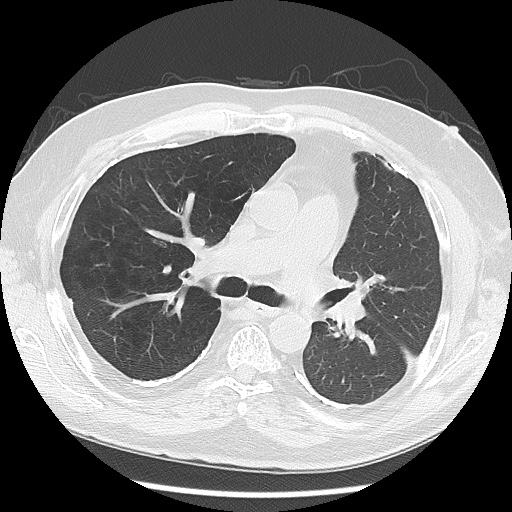 Asbestos-related pleural disease (Radiopaedia 74366-85250 Axial lung window 52).jpg