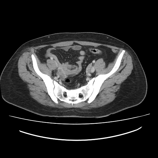 Ascending retrocecal appendicitis with liver abscesses (Radiopaedia 60066-67615 B 72).jpg