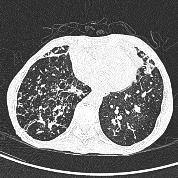 Aspergilloma- with Monod sign (Radiopaedia 44737-48532 Axial lung window 200).jpg