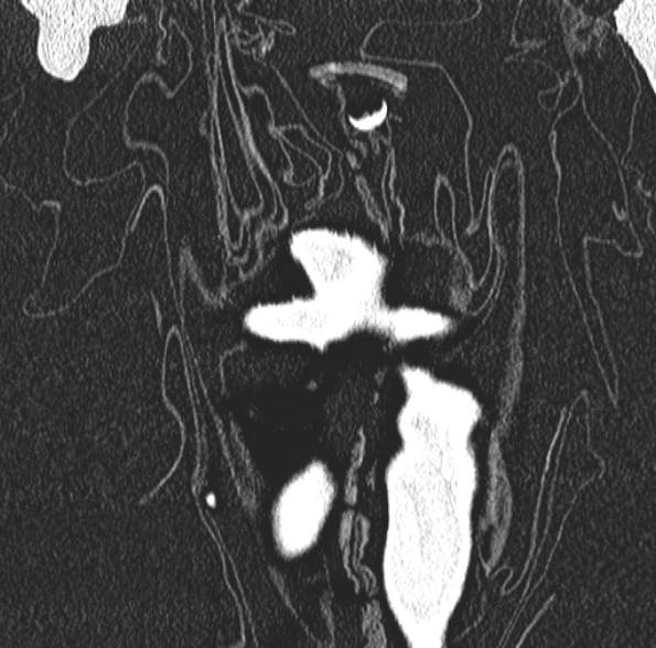 File:Aspergilloma- with Monod sign (Radiopaedia 44737-48532 Coronal lung window 102).jpg