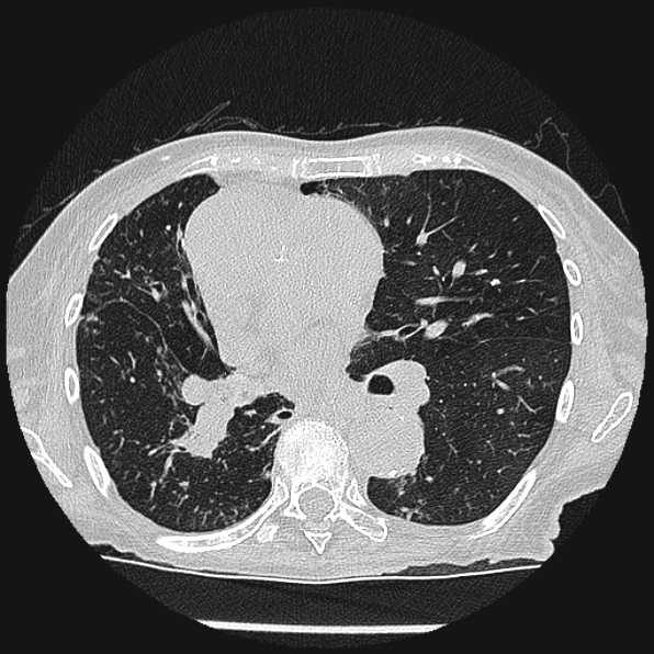Aspergilloma (Radiopaedia 24458-24763 Axial lung window 34).jpg