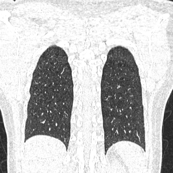 File:Aspergilloma (Radiopaedia 26223-26347 Coronal lung window 45).jpg