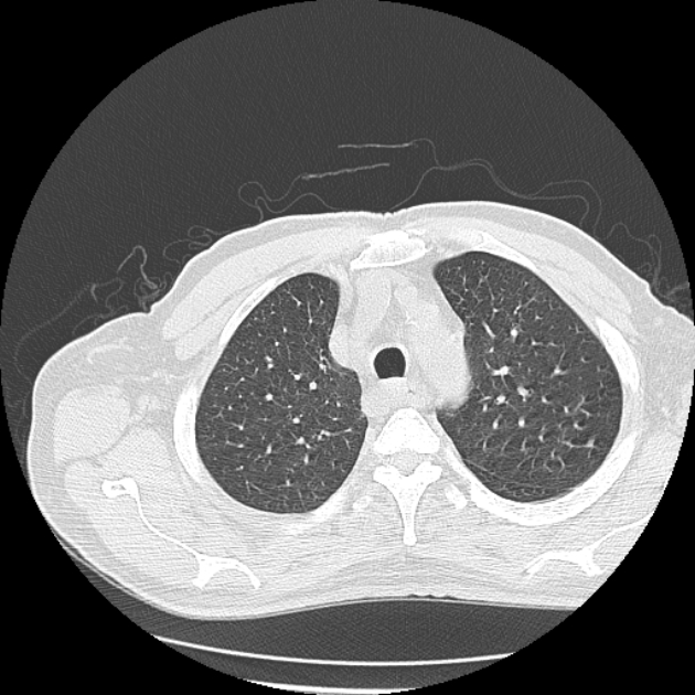 Aspergilloma (Radiopaedia 44592-48327 Axial lung window 15).jpg