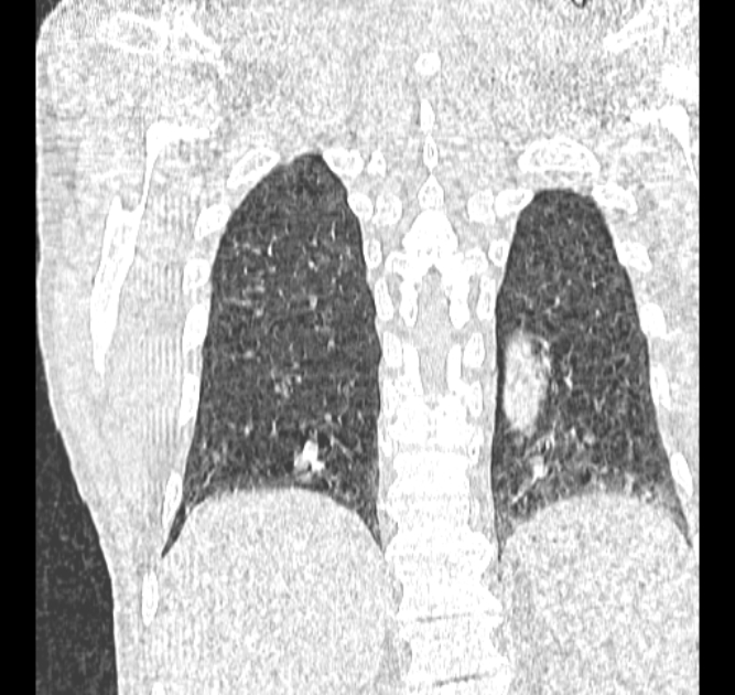 Aspergilloma (Radiopaedia 44592-48327 Coronal lung window 106).jpg