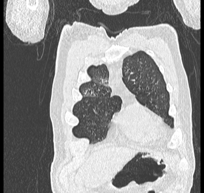 Aspergilloma (Radiopaedia 44592-48327 Coronal lung window 9).jpg