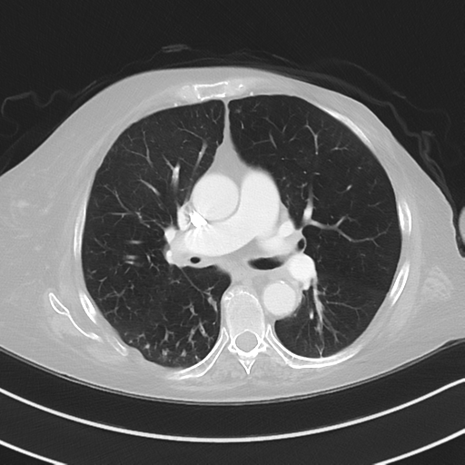 Aspiration bronchiolitis (Radiopaedia 53464-59463 Axial lung window 26).png