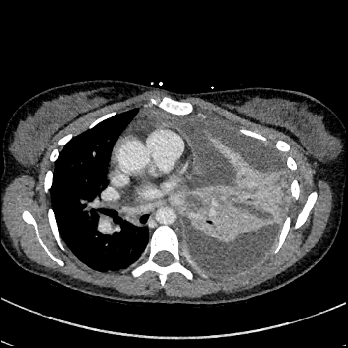 Aspiration pneumonia complicated by empyema (Radiopaedia 73024-83767 B 169).jpg