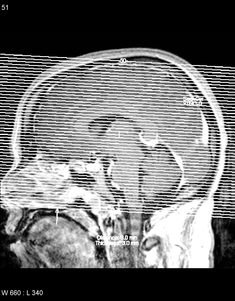Astroblastoma (Radiopaedia 39792-42218 Axial T1 C+ 50).jpg