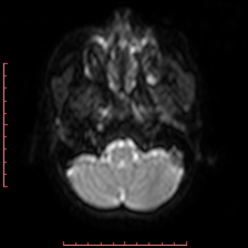 Astroblastoma (Radiopaedia 74287-85162 Axial DWI 6).jpg
