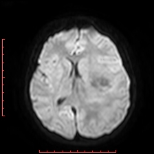 Astroblastoma (Radiopaedia 74287-85162 Axial DWI 60).jpg