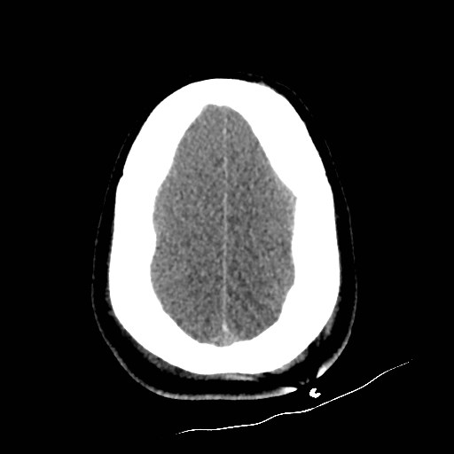 File:Atlanto-occipital dislocation (Radiopaedia 44648-48412 Axial non-contrast 47).jpg