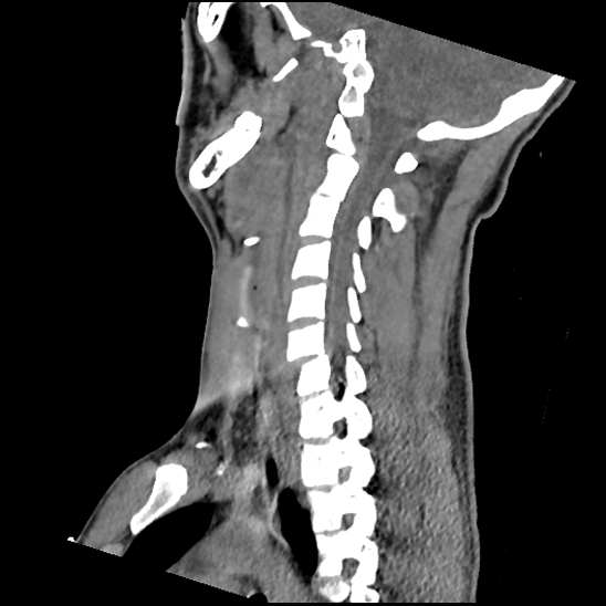 File:Atlanto-occipital dissociation (Traynelis type 1), C2 teardrop fracture, C6-7 facet joint dislocation (Radiopaedia 87655-104061 D 51).jpg